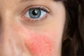 Ani yüz kızarması