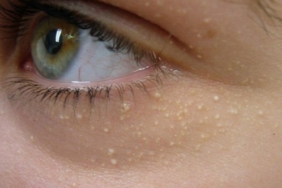 Cildimizdeki Küçük Beyaz Noktalar Neden Olur?