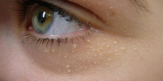 Cildimizdeki Küçük Beyaz Noktalar Neden Olur?