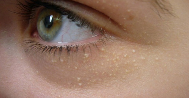 Cildimizdeki Küçük Beyaz Noktalar Neden Olur?