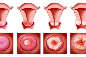 Dogumdan Sonra Rahimde Parça Kalmasi Belirtileri