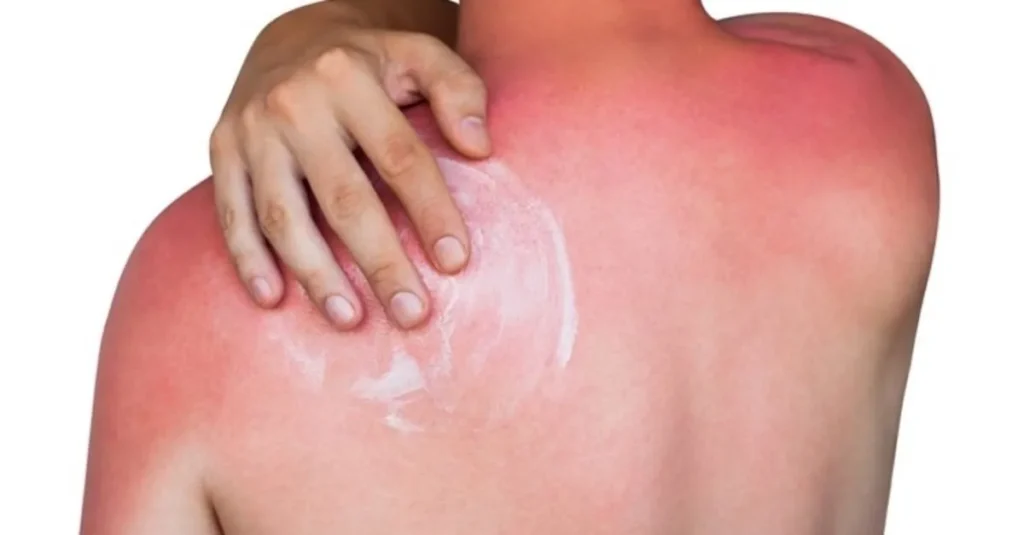 Güneş Yanığı Nasıl Geçer? Doğal Tedavi Yolları Nelerdir?