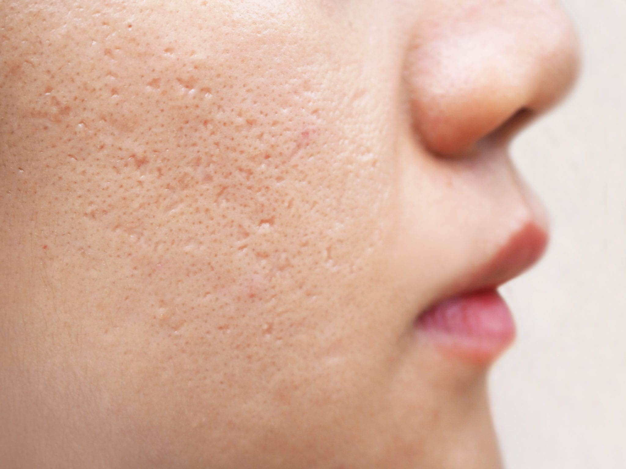 9 Helpful Steps to Consider When Acne Persists